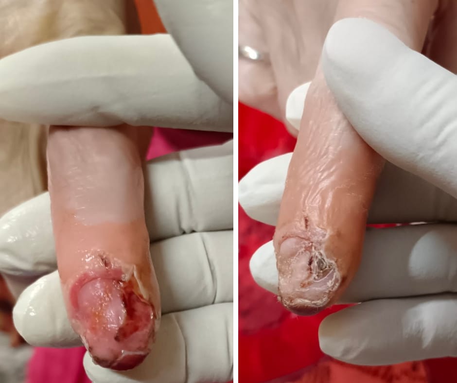 Finger wound dressing documentation image
