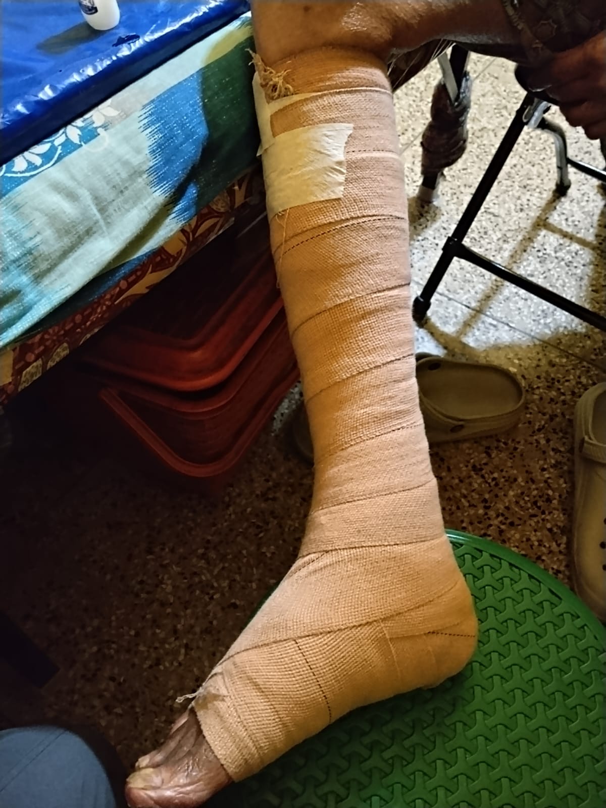 Multilayer compression therapy being conducted for a patient at home