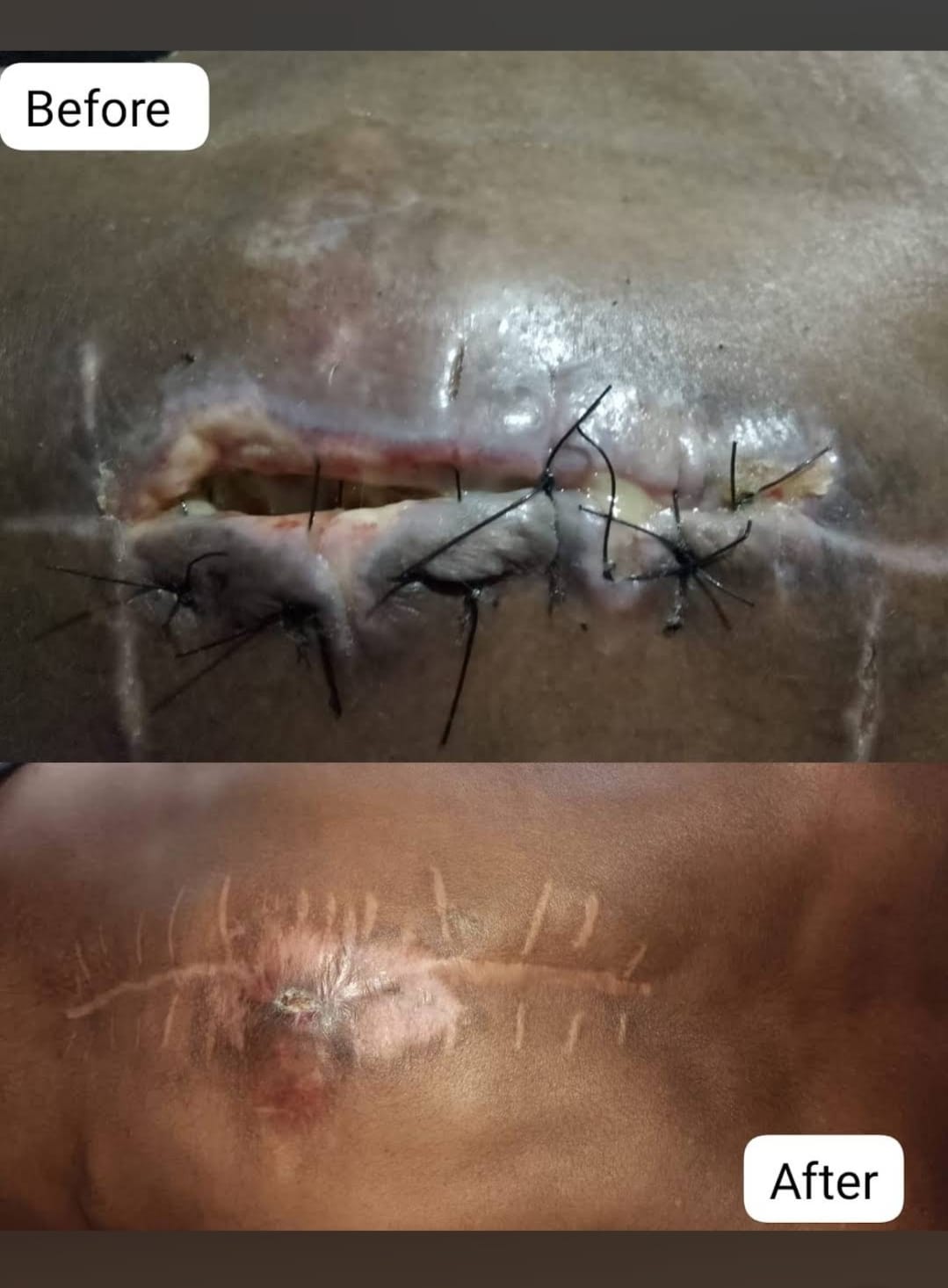 Post-operative spinal incision dressing documentation