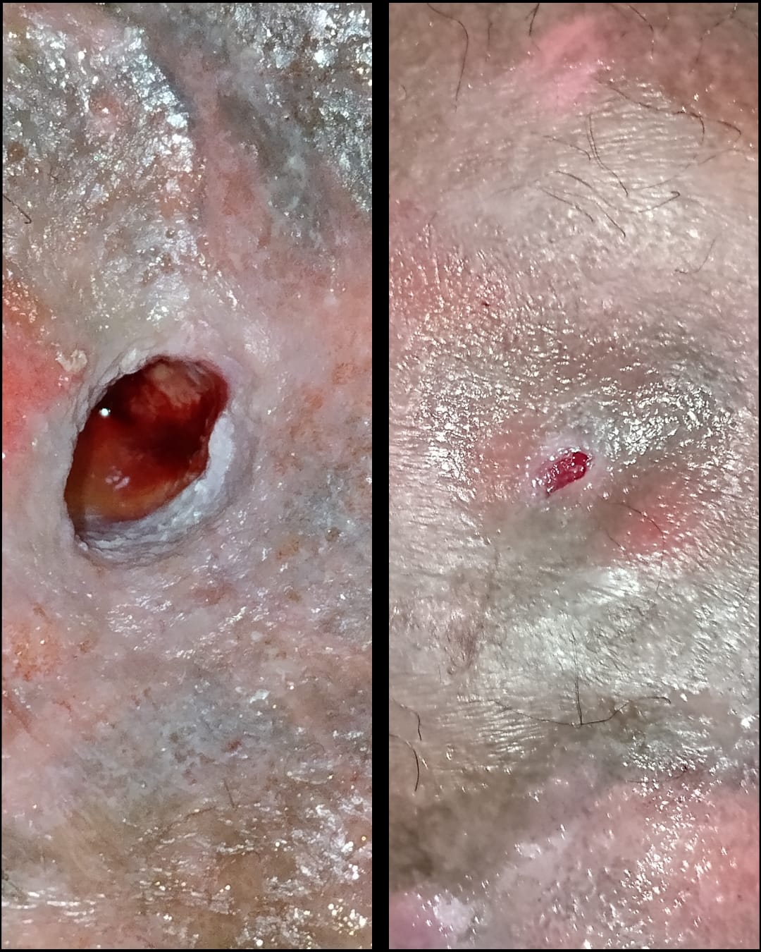 Tunnel-wound dressing documentation image