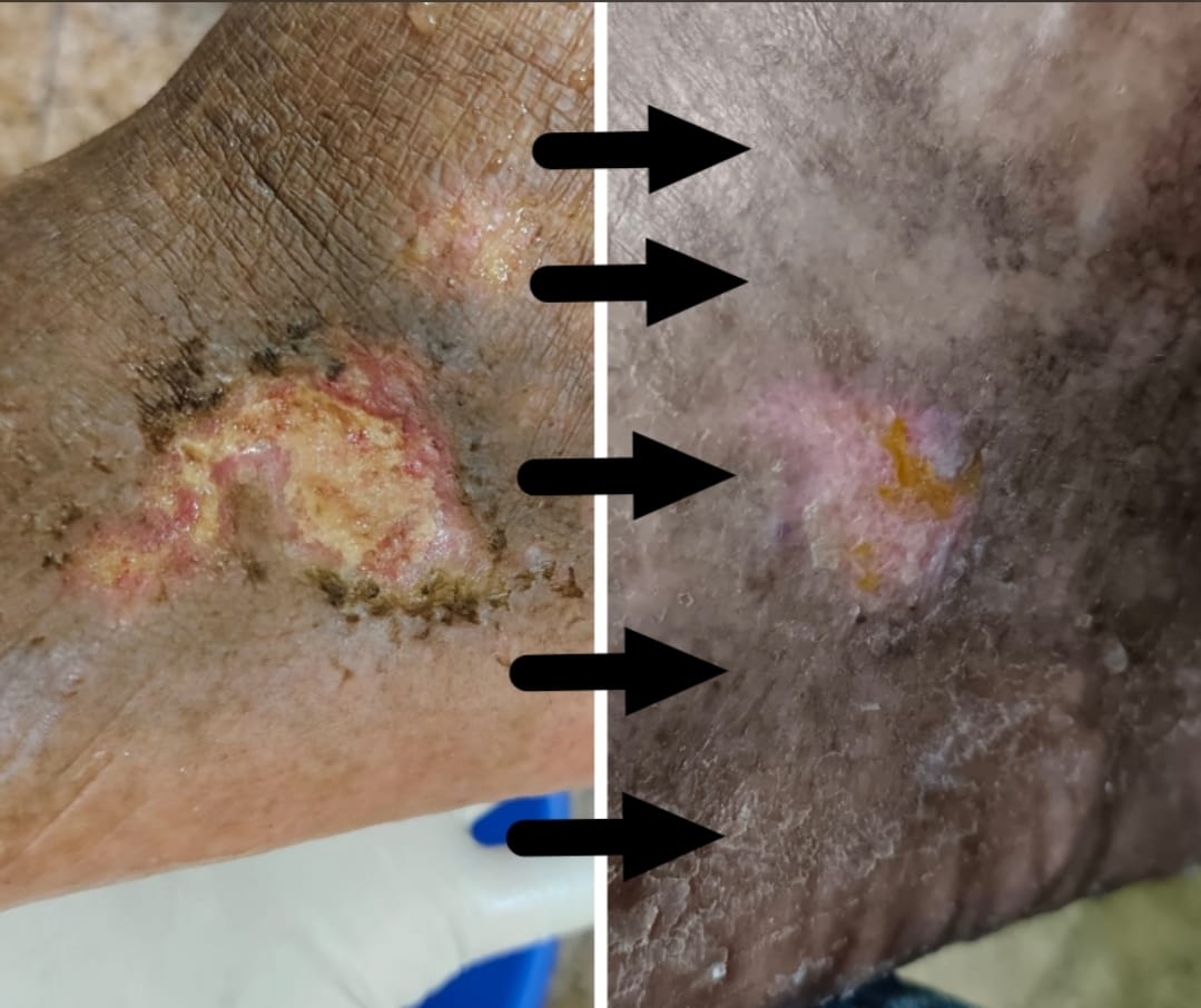 Lower-limb wound dressing documentation image