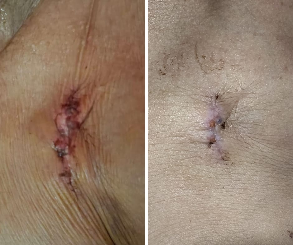 Pacemaker implantation incision-site dressing documentation